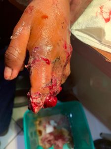 Menor de edad pierde dedos de su mano en accidente en Simojovel 